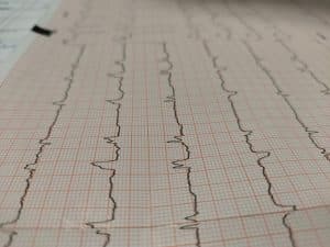 Comprendre l'ECG : guide pratique pour interpreter les résultats